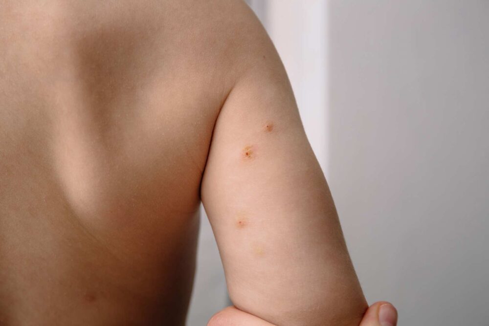 Molluscum contagiosum