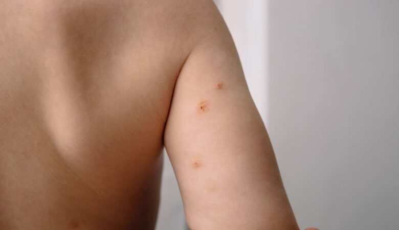 Molluscum contagiosum